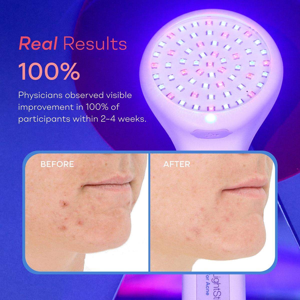 LightStim for Acne