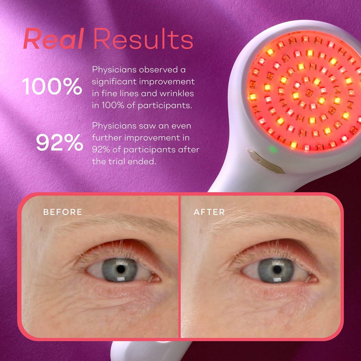 LightStim for Wrinkles